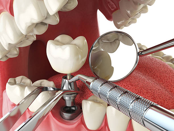 Best Urgent Tooth Repair  in Clayton, MO